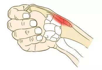 手指屈肌腱腱鞘炎是什么?